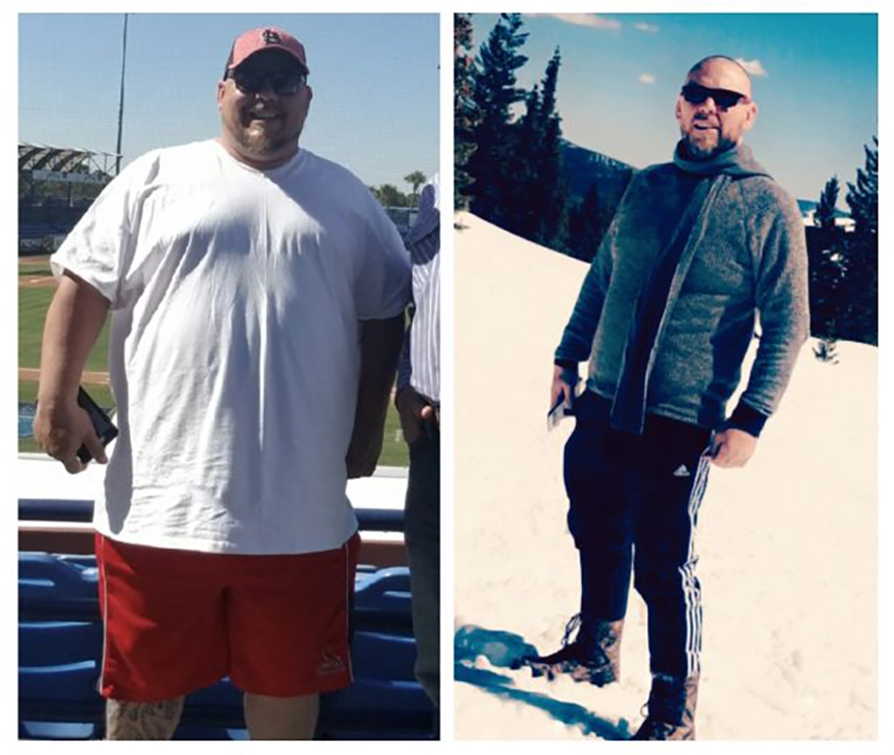 Overweight-Man-Before-and-After-Surgery