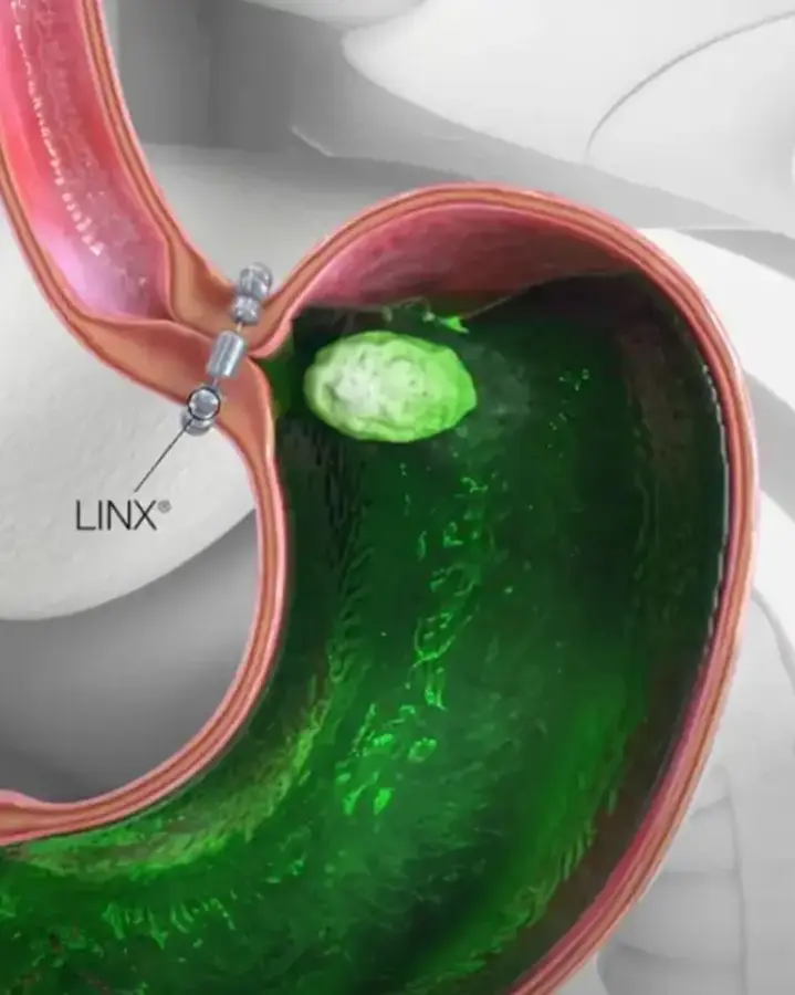 linx reflux example with stomach model