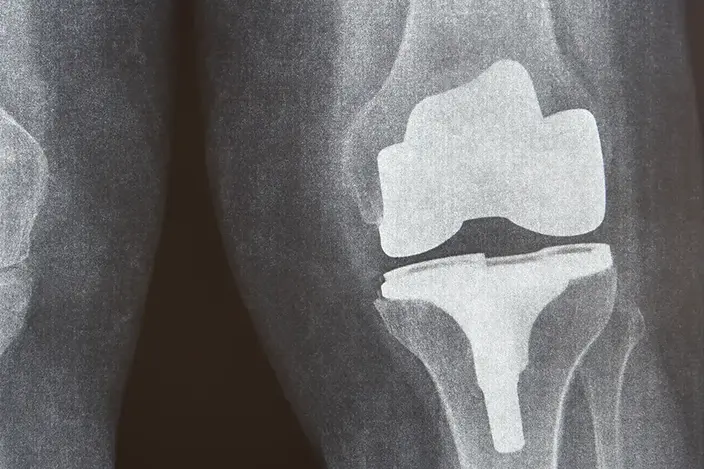 x-ray of a knee