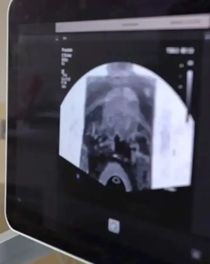 UroNav machine with scan on screen